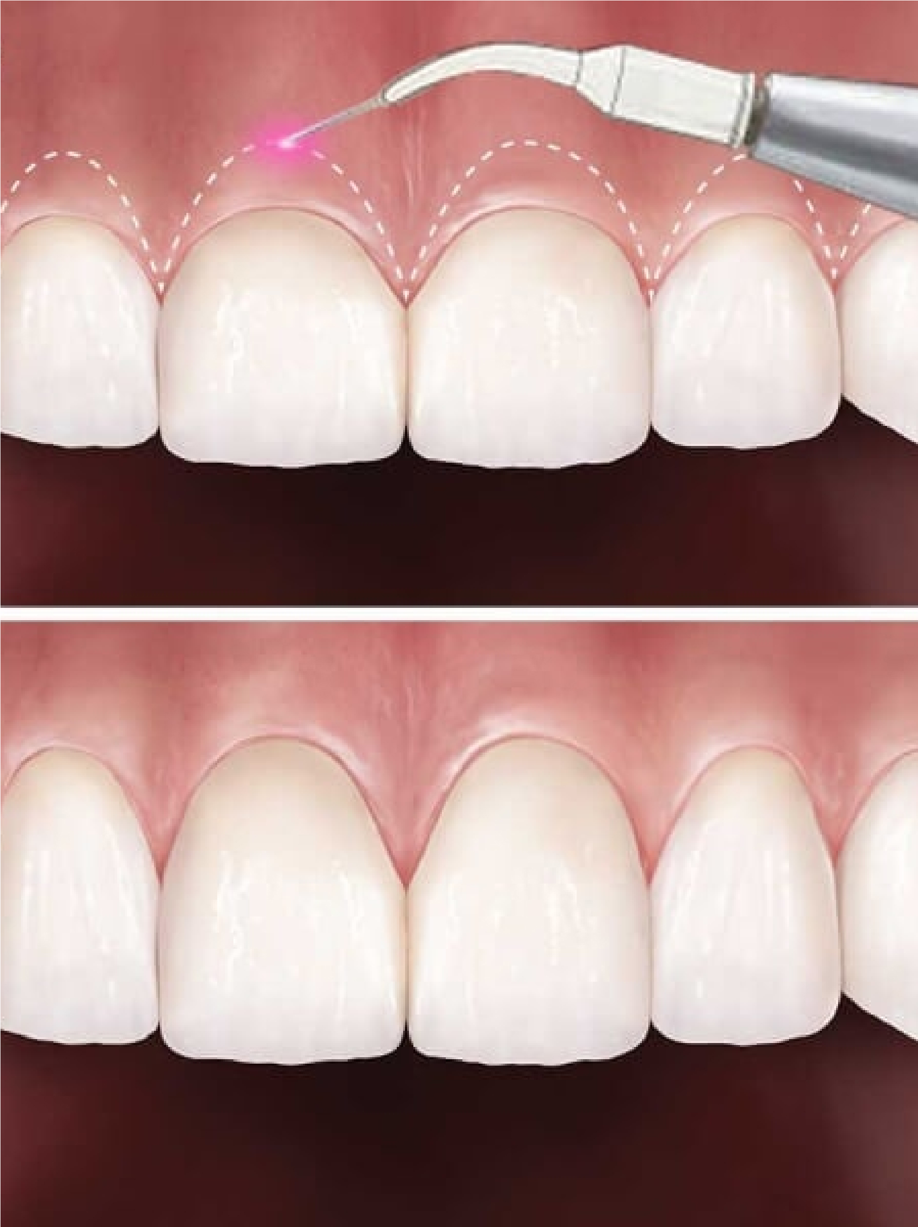 Treatment of gummy smile