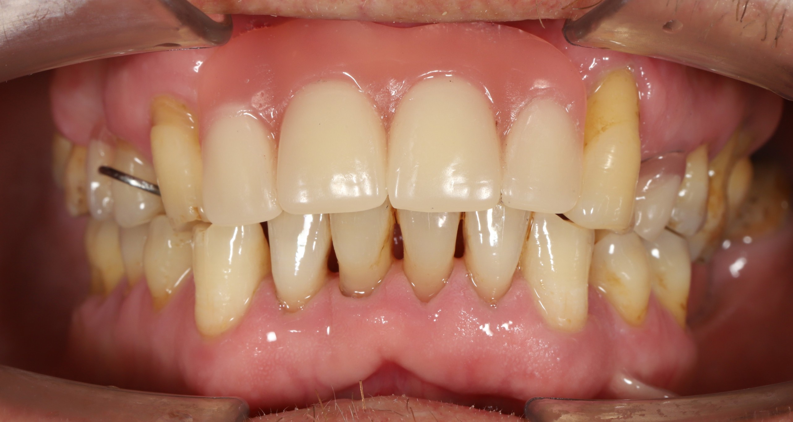 Kết quả điều trị — Neodent Implant Placement & Cercon Porcelain Restoration