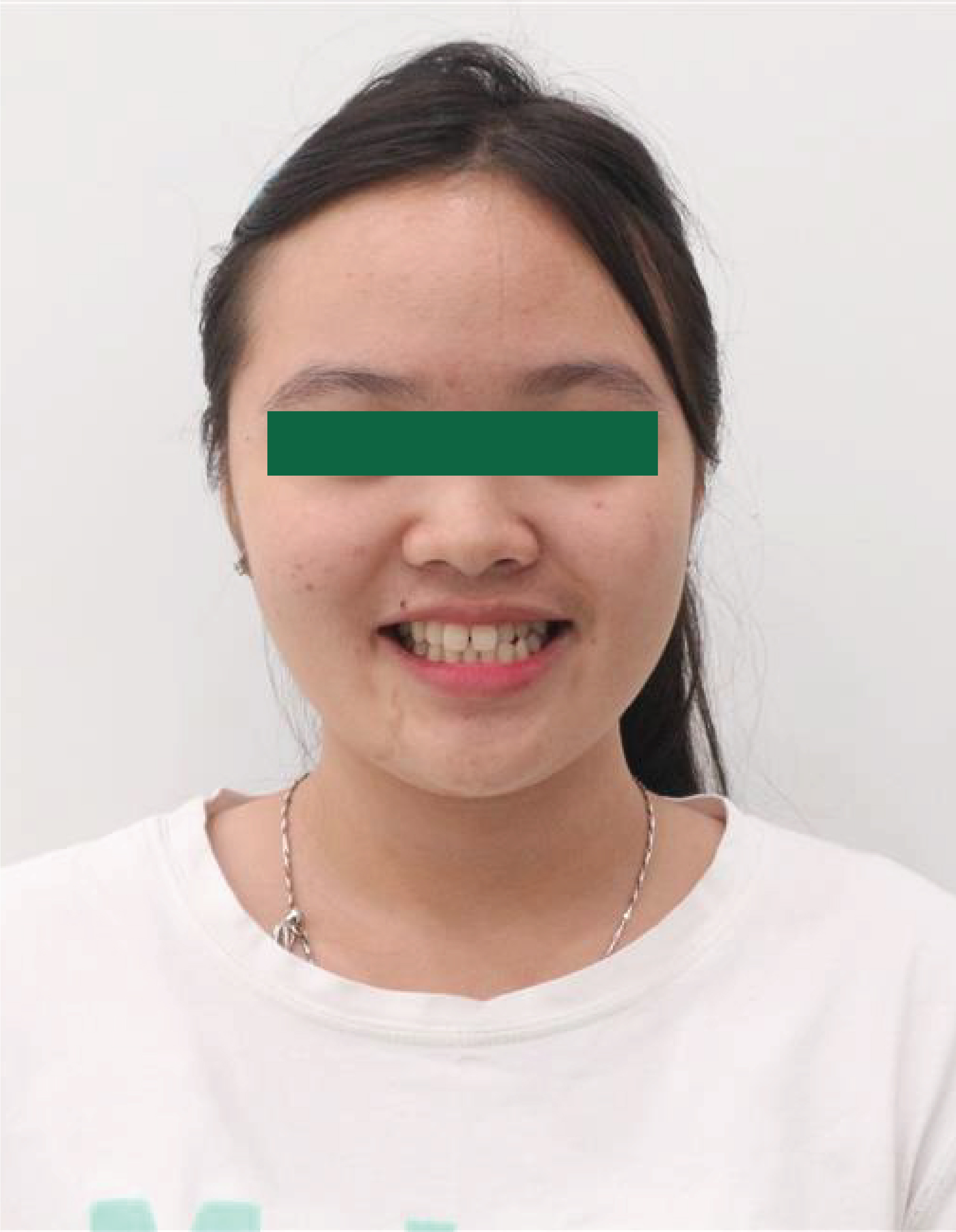 Braces - Correcting Crowded Teeth & Erupting Impacted Teeth
