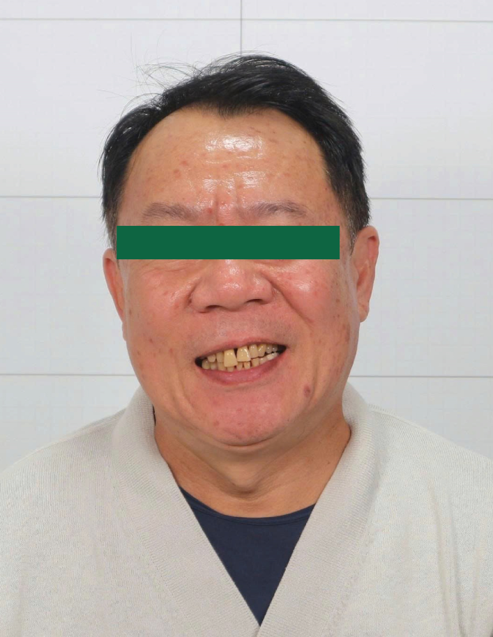 Premium porcelain crowns (Cercon)