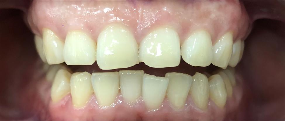 Completion of ClearCorrect Aligners - Radiant Smile, Timely Tray Removal