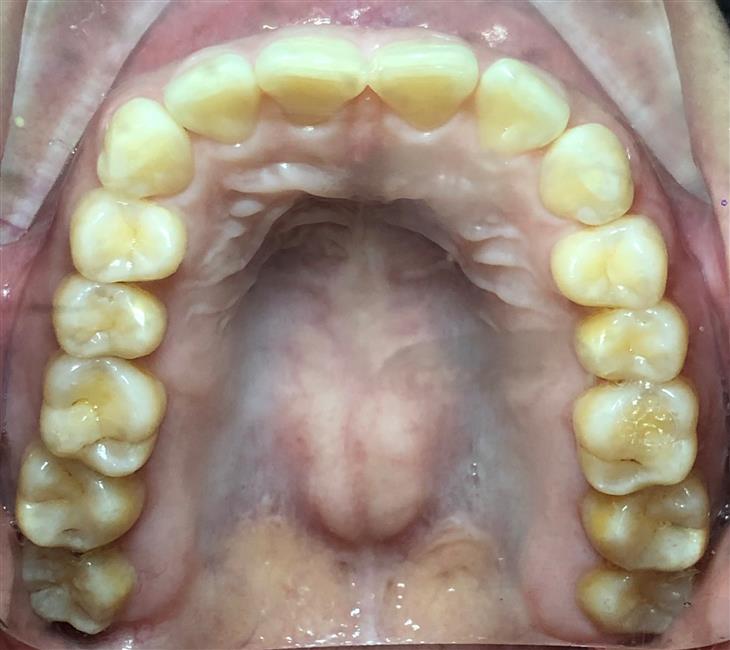 Completion of ClearCorrect Aligners - Radiant Smile, Timely Tray Removal