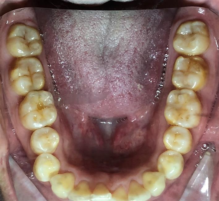 Completion of ClearCorrect Aligners - Radiant Smile, Timely Tray Removal
