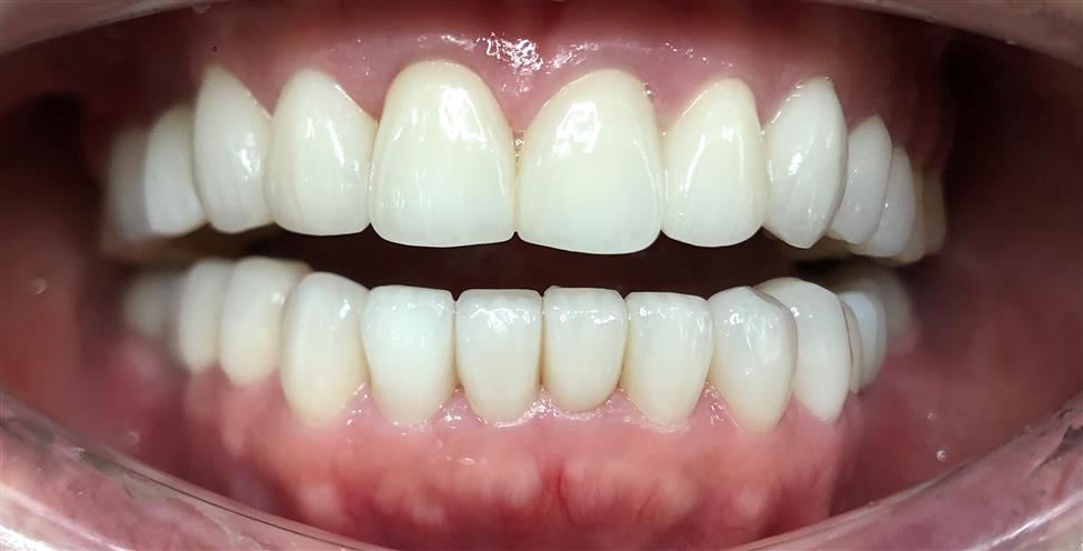 Kết quả điều trị — Премиальные керамические коронки (Cercon)