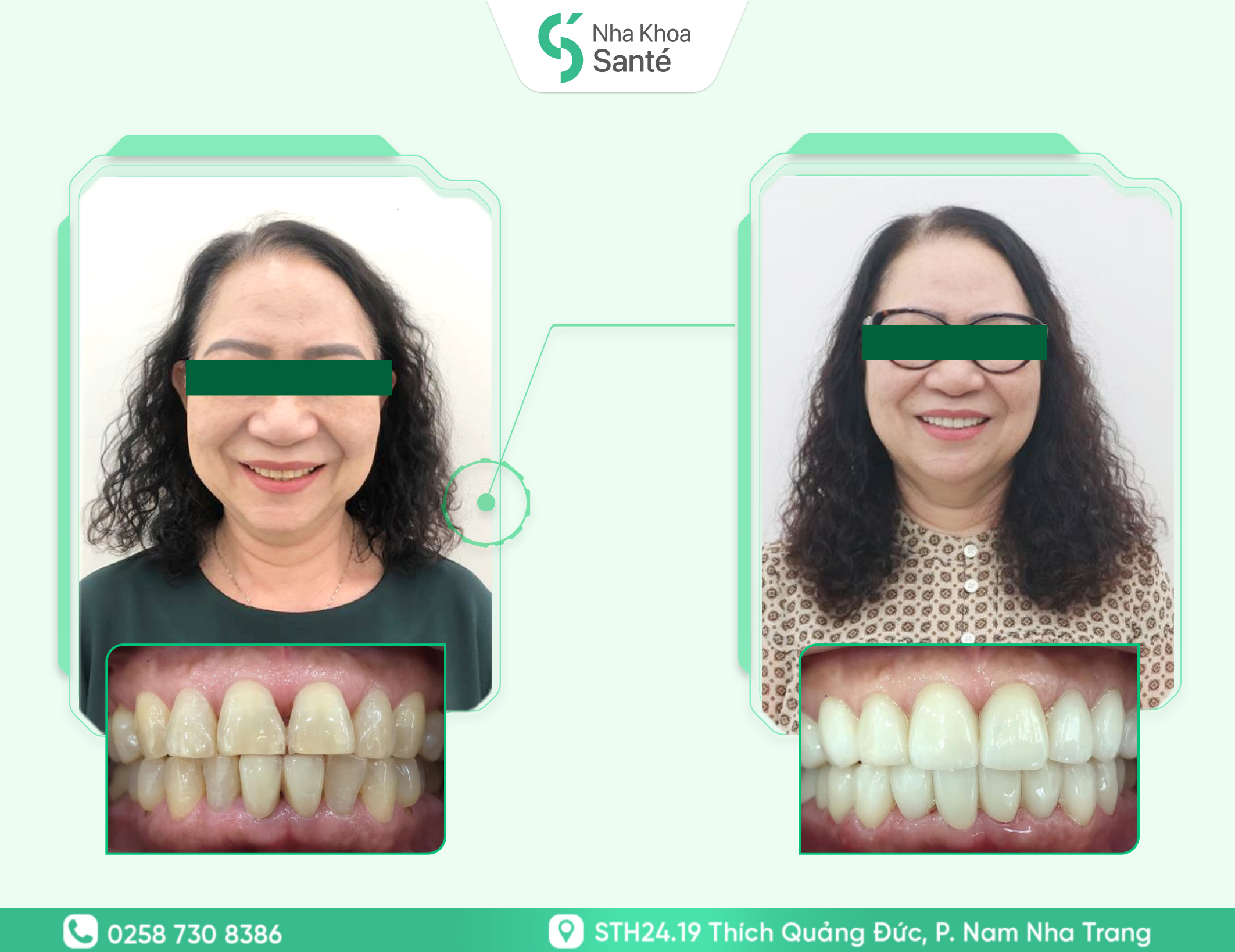 Case-dan-veneer ( 2 )