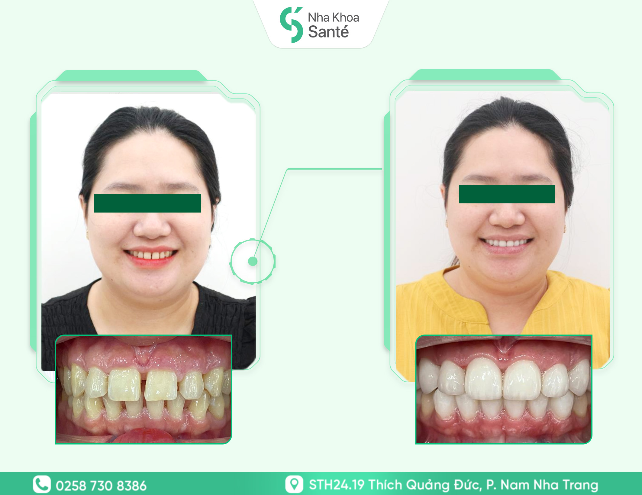 Case-dan-veneer (1)