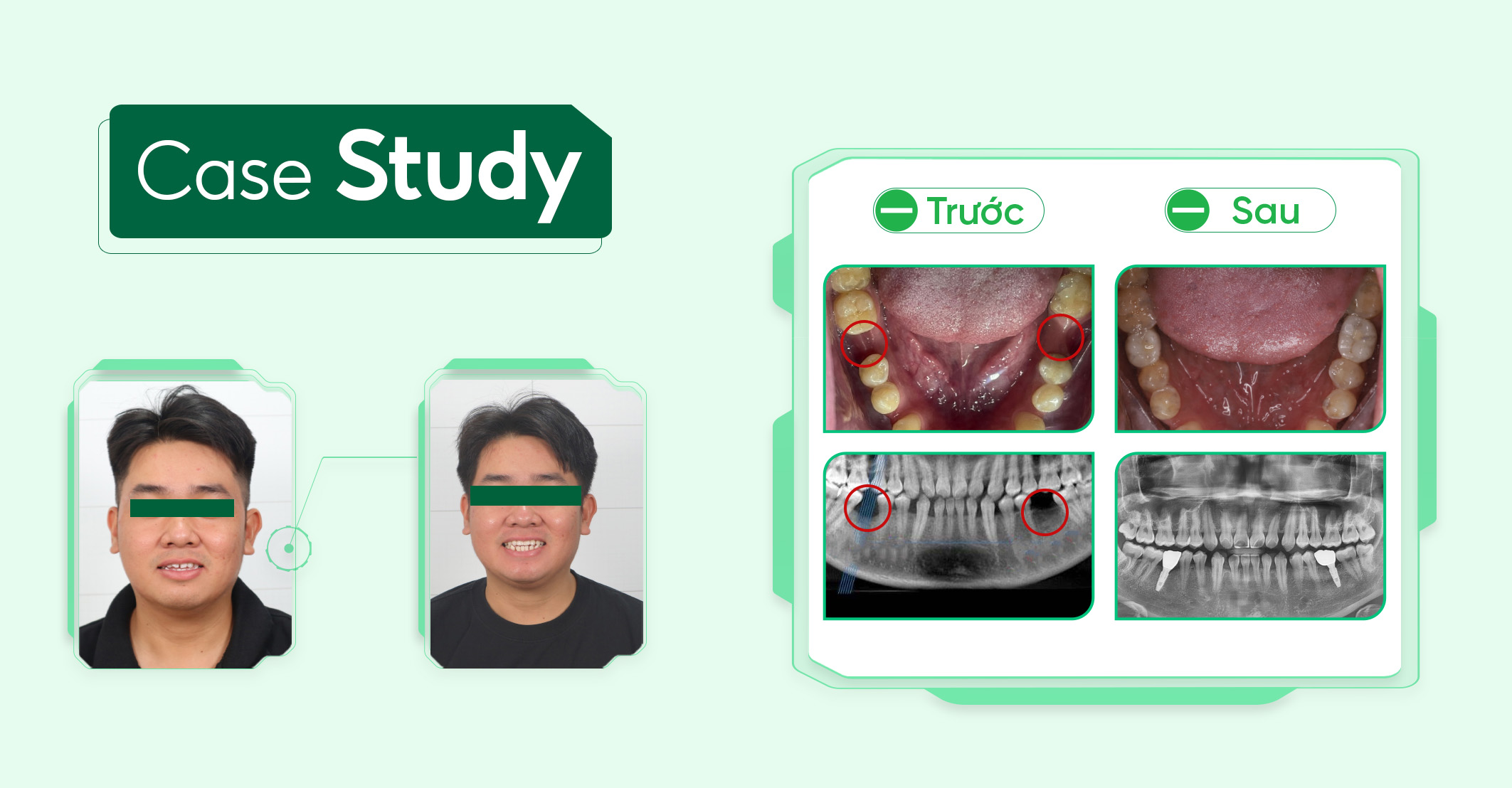 Case-implant-vai-rang (2)