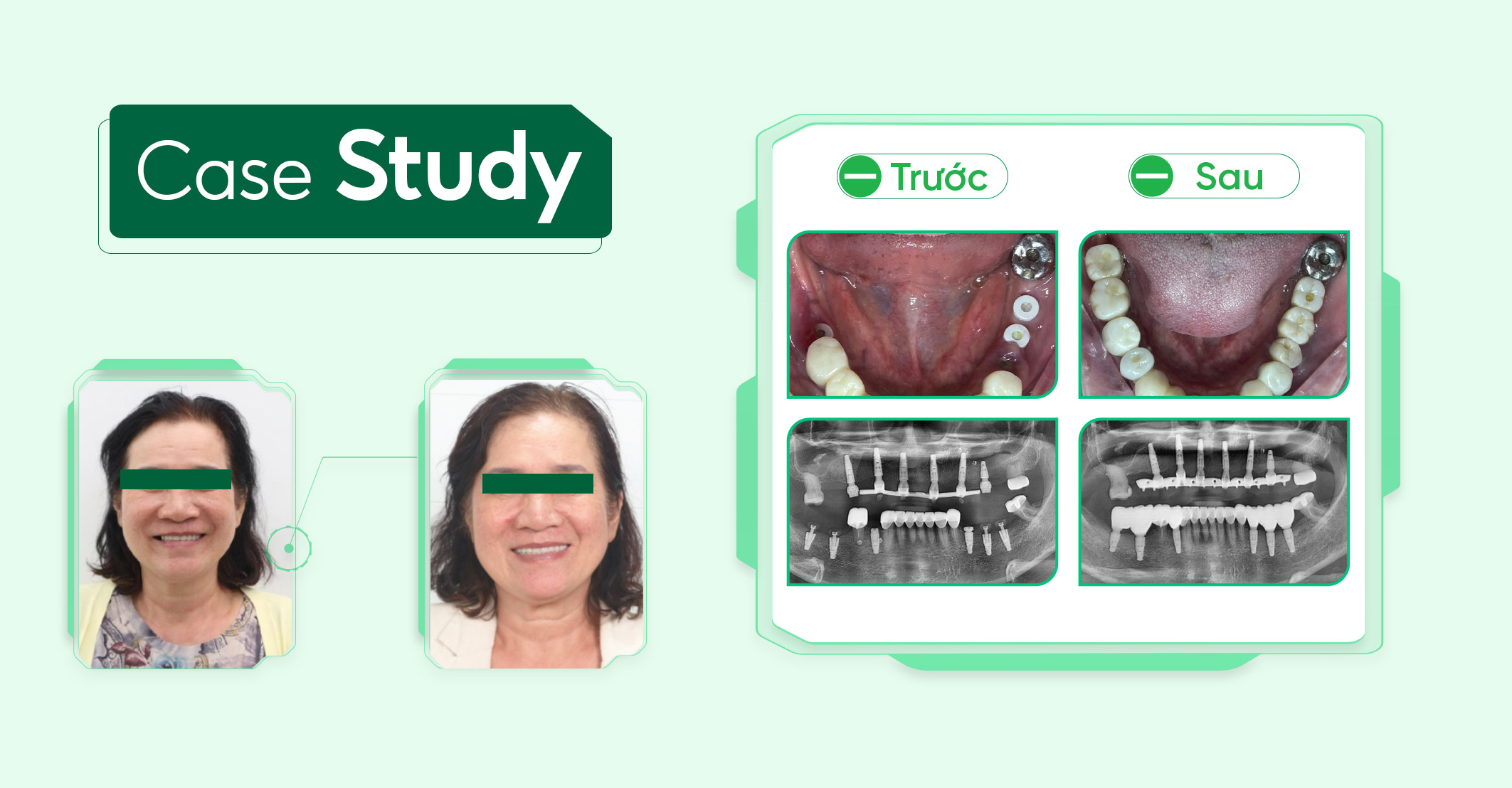 Case-phuc-hinh-rang-sư ( 1 )