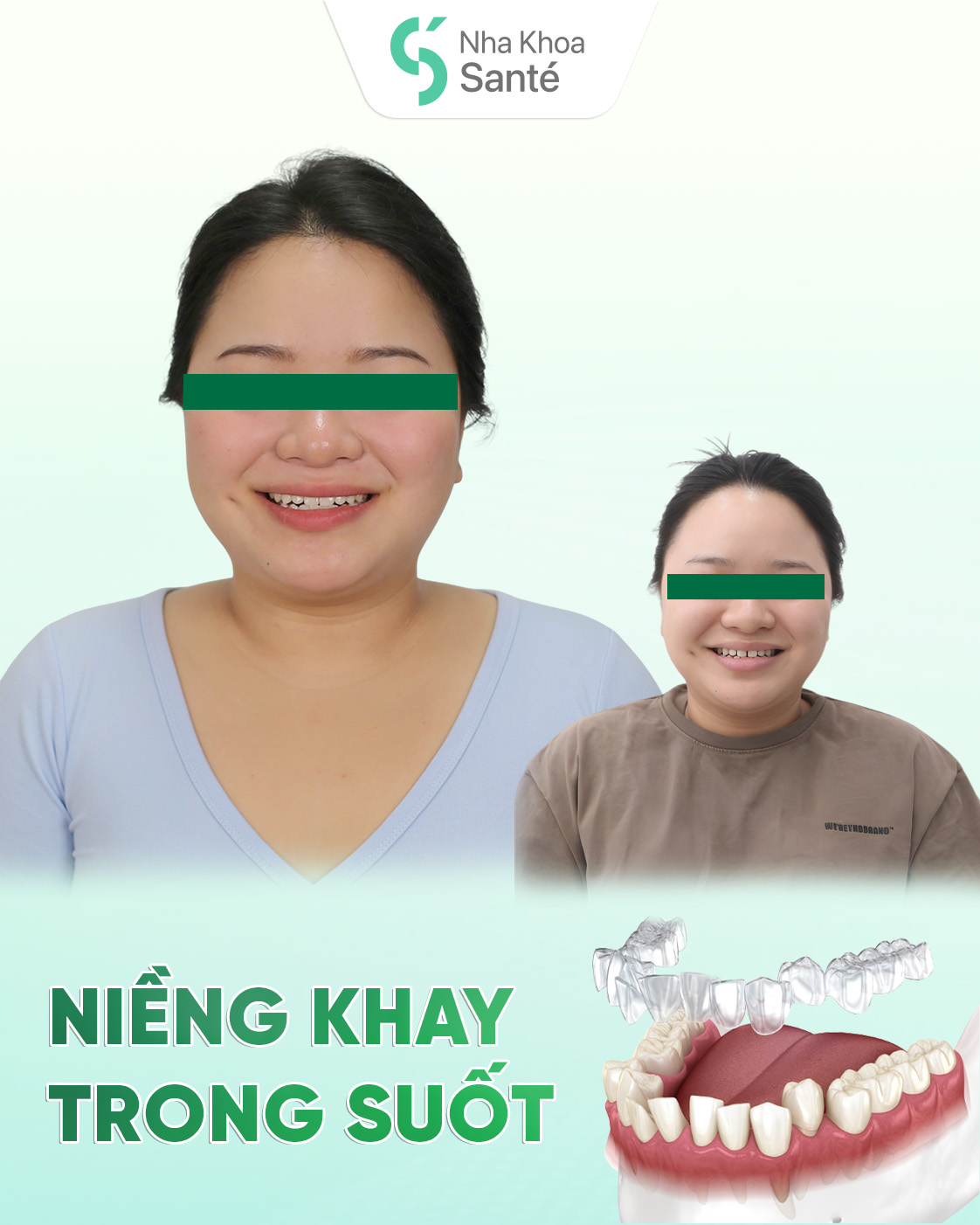 Niềng răng trong suốt ClearCorrect – Tái tạo nụ cười hoàn mỹ, không lộ mắc cài