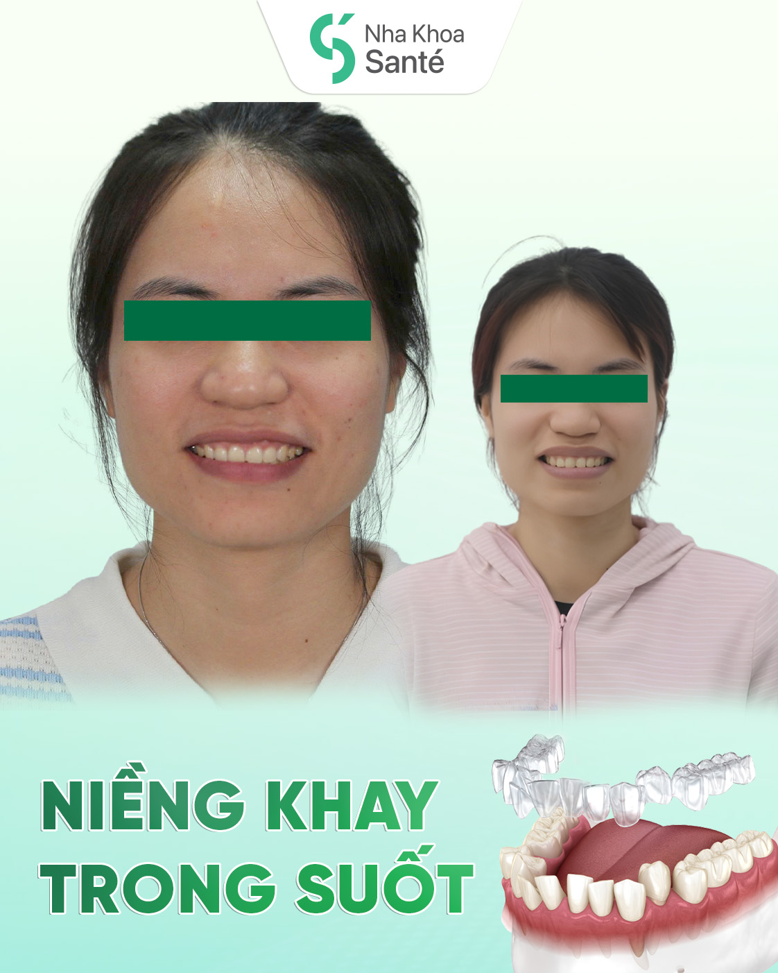 Completion of ClearCorrect Aligners - Radiant Smile, Timely Tray Removal