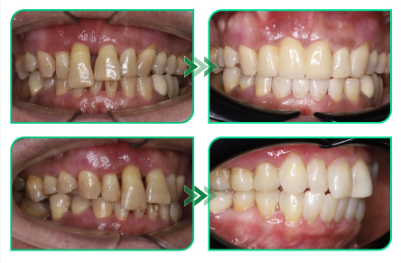 Kết quả điều trị — Premium porcelain crowns (Cercon)