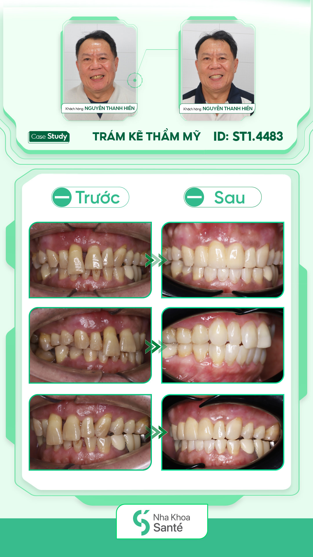 Premium porcelain crowns (Cercon)