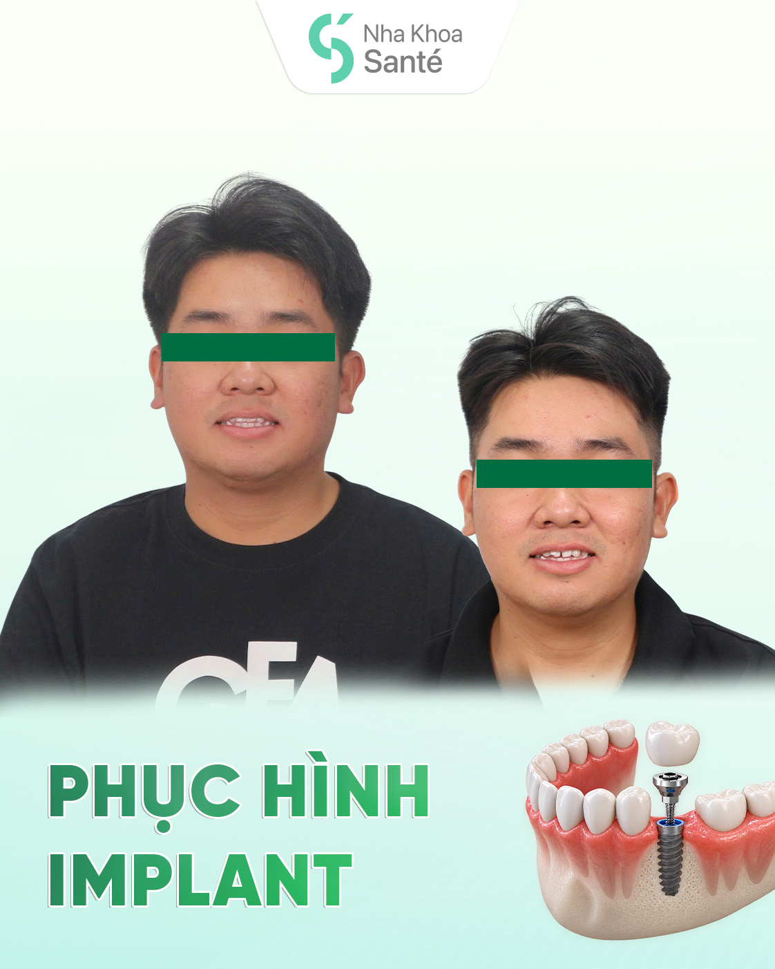Cấy ghép Implant BioTem và Phục hình Răng sứ Zirconia – Khôi phục răng hàm