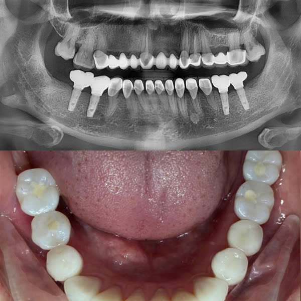 Sau điều trị