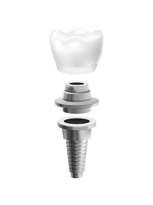 Single Tooth Implant Placement