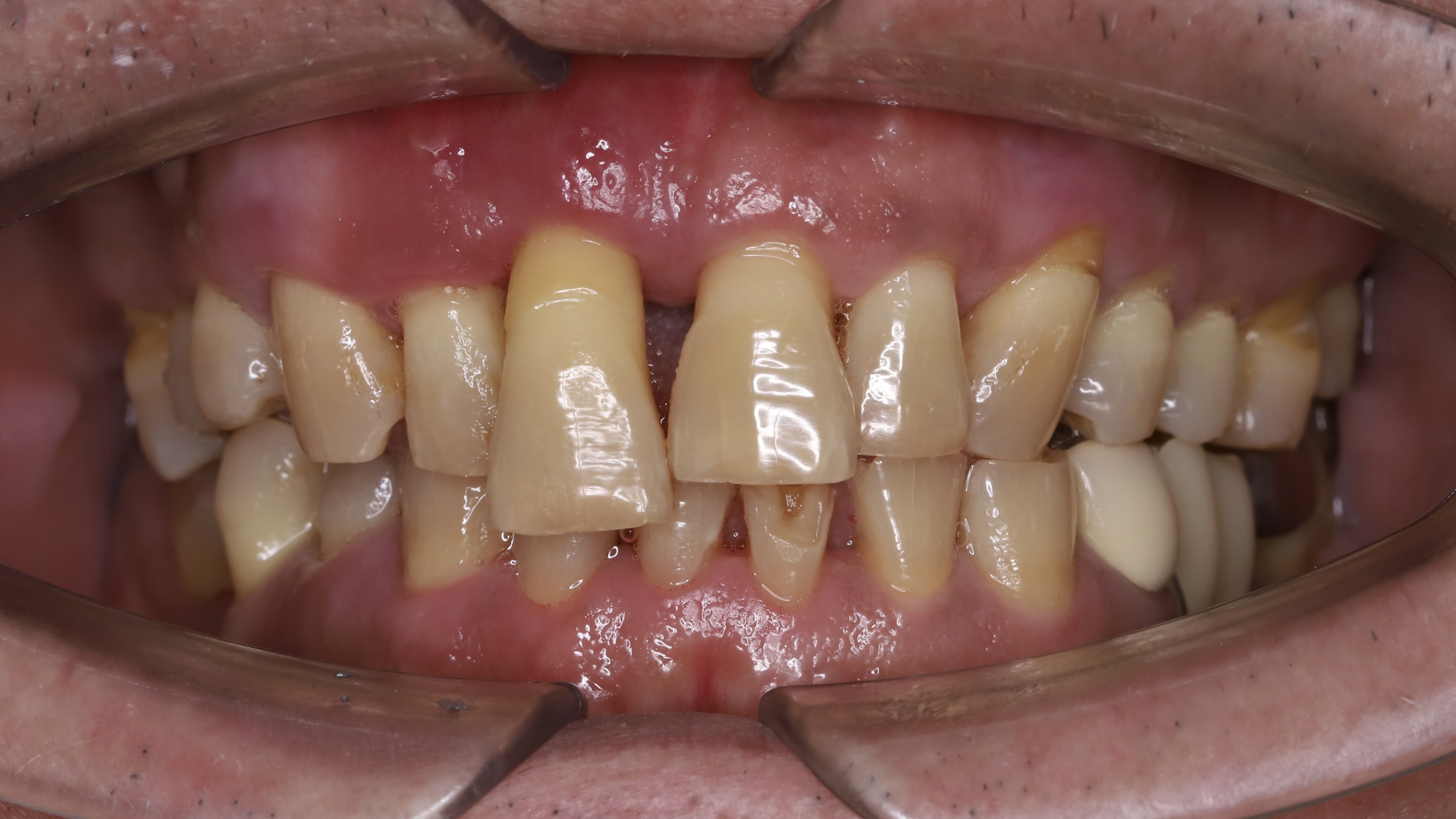 Premium porcelain crowns (Cercon)
