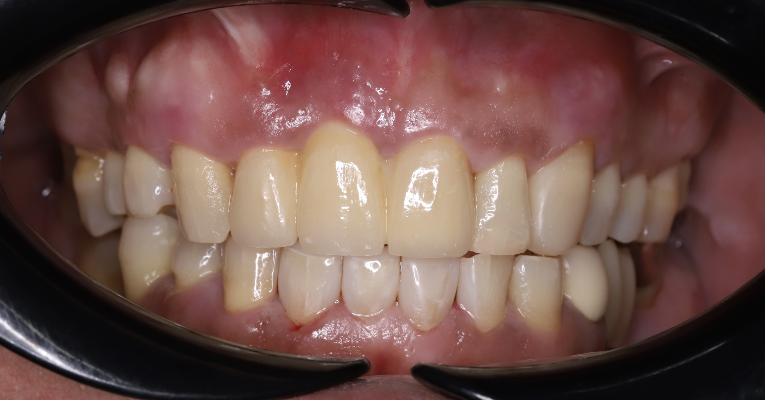 Premium porcelain crowns (Cercon)