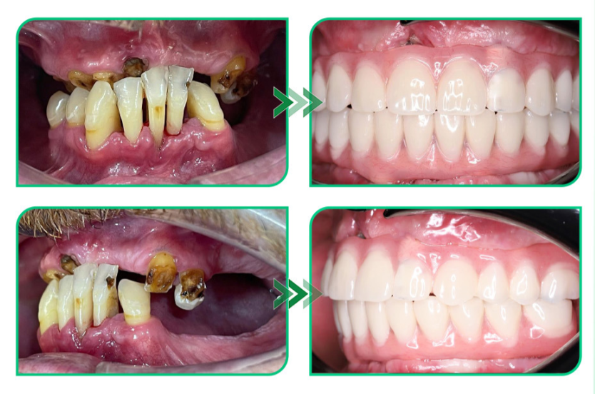 Kết quả điều trị — Full Arch Implant All On 6