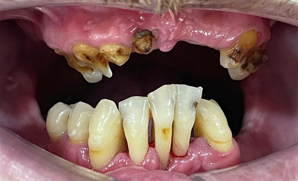 Full Arch Implant All On 6
