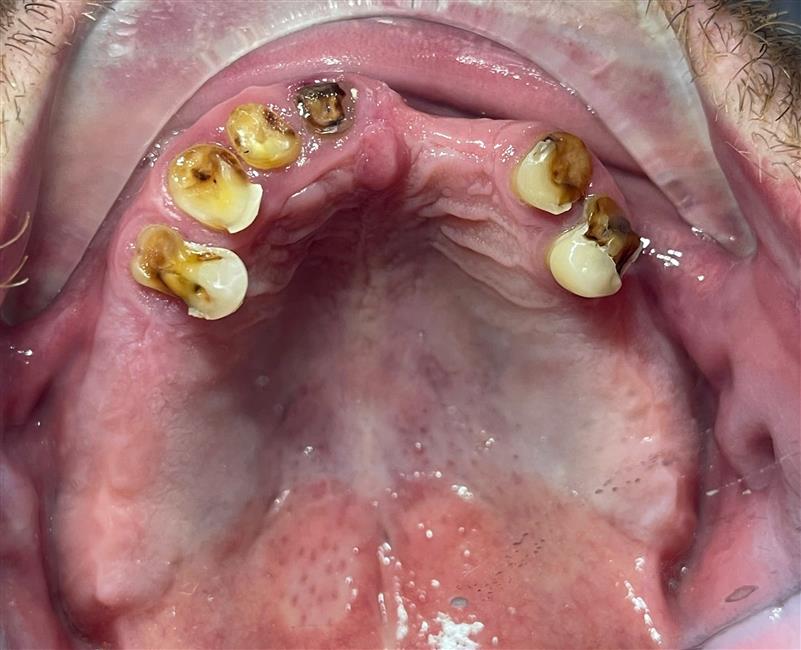 Full Arch Implant All On 6