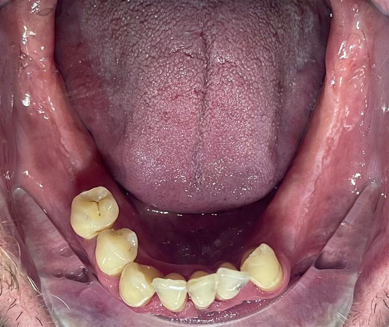 Full Arch Implant All On 6