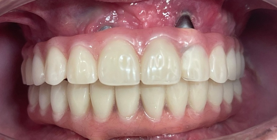 Full Arch Implant All On 6
