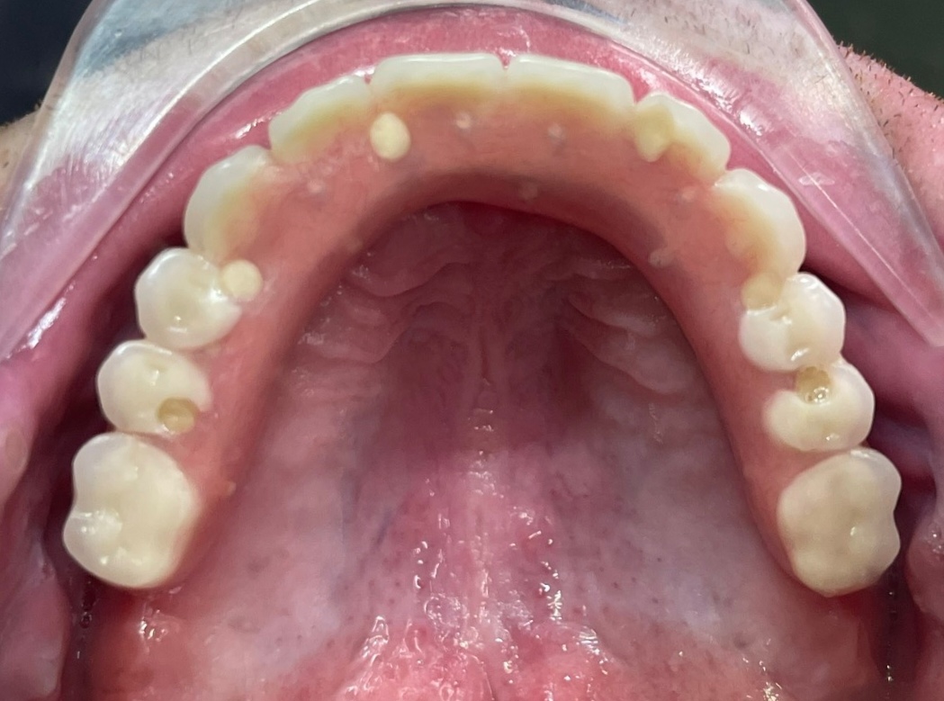 Full Arch Implant All On 6