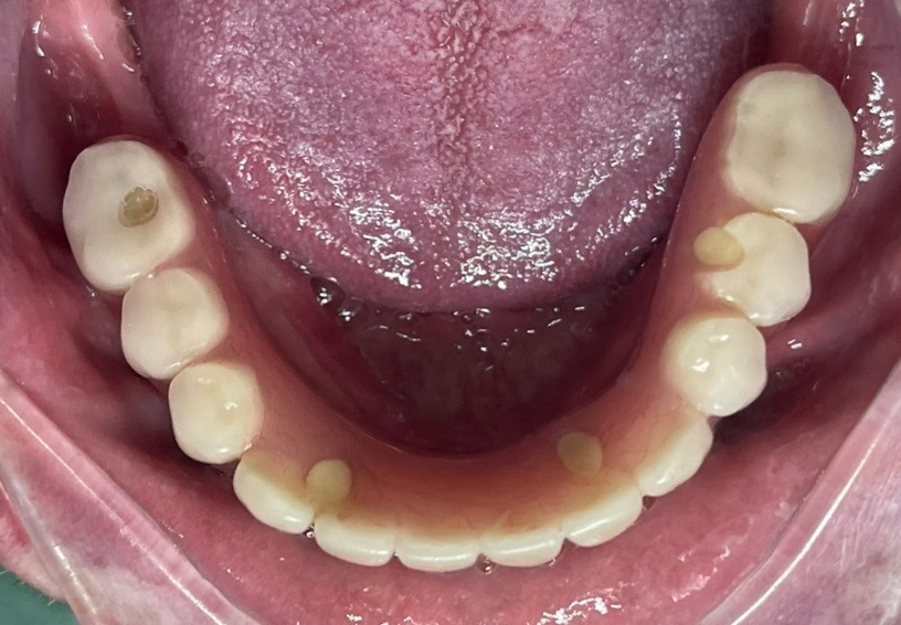 Full Arch Implant All On 6
