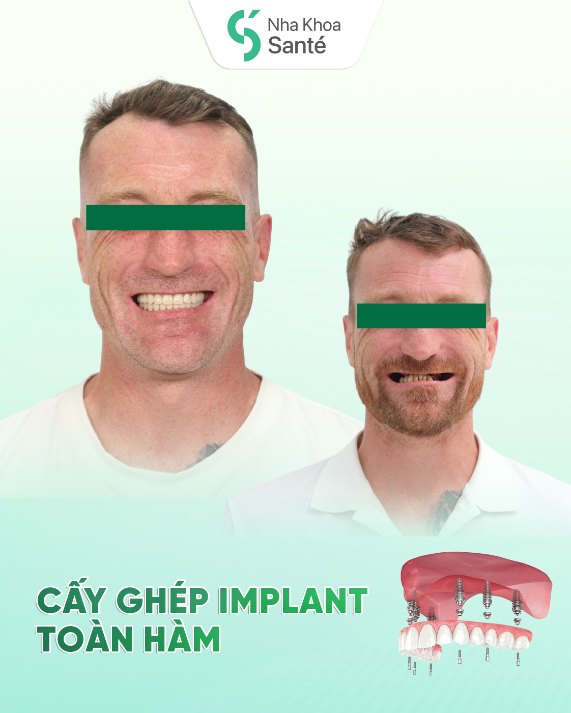 Full Arch Implant All On 6