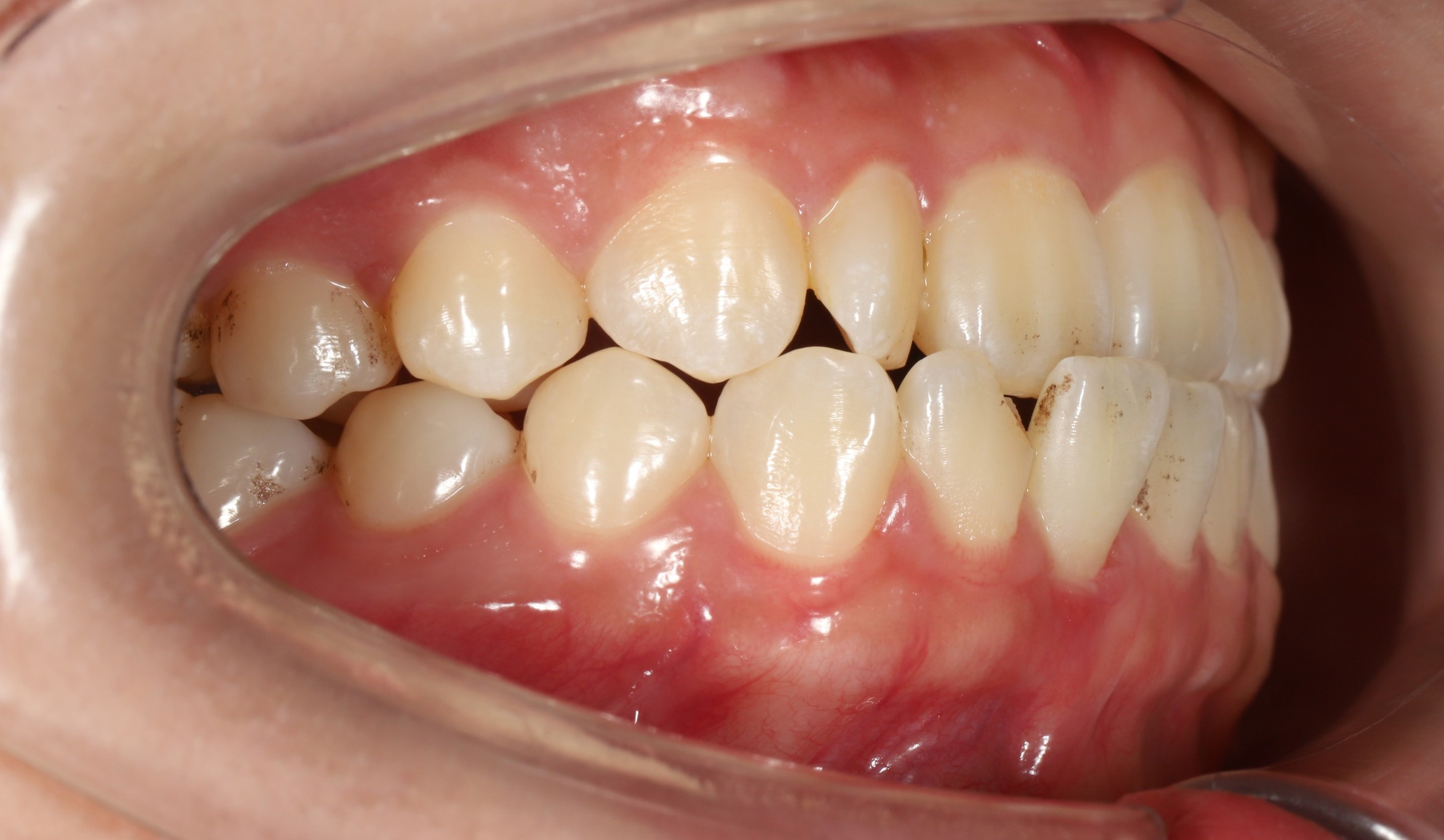 Trước điều trị