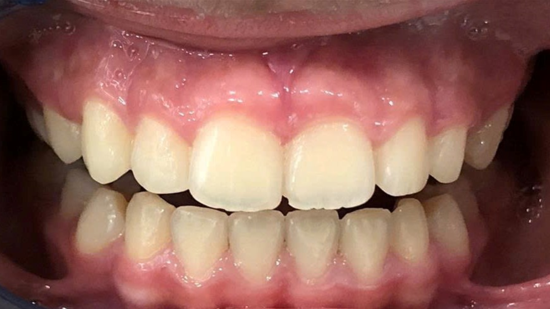 Trước điều trị