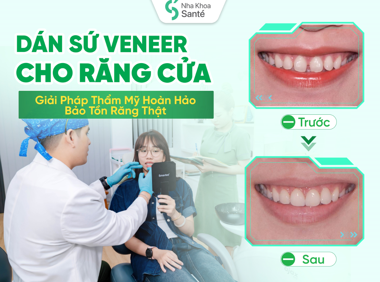 Porcelain Veneers for Front Teeth: The Perfect Aesthetic Solution to Preserve Natural Teeth