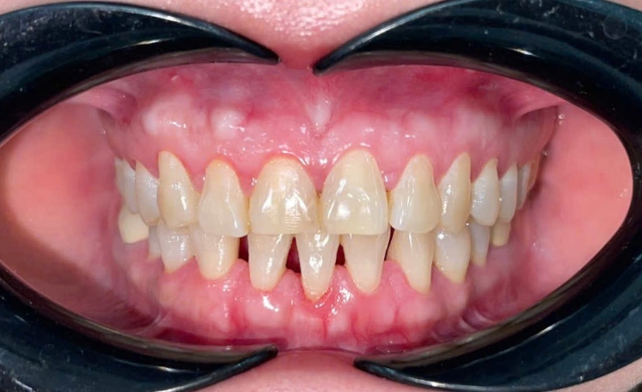 Trước điều trị