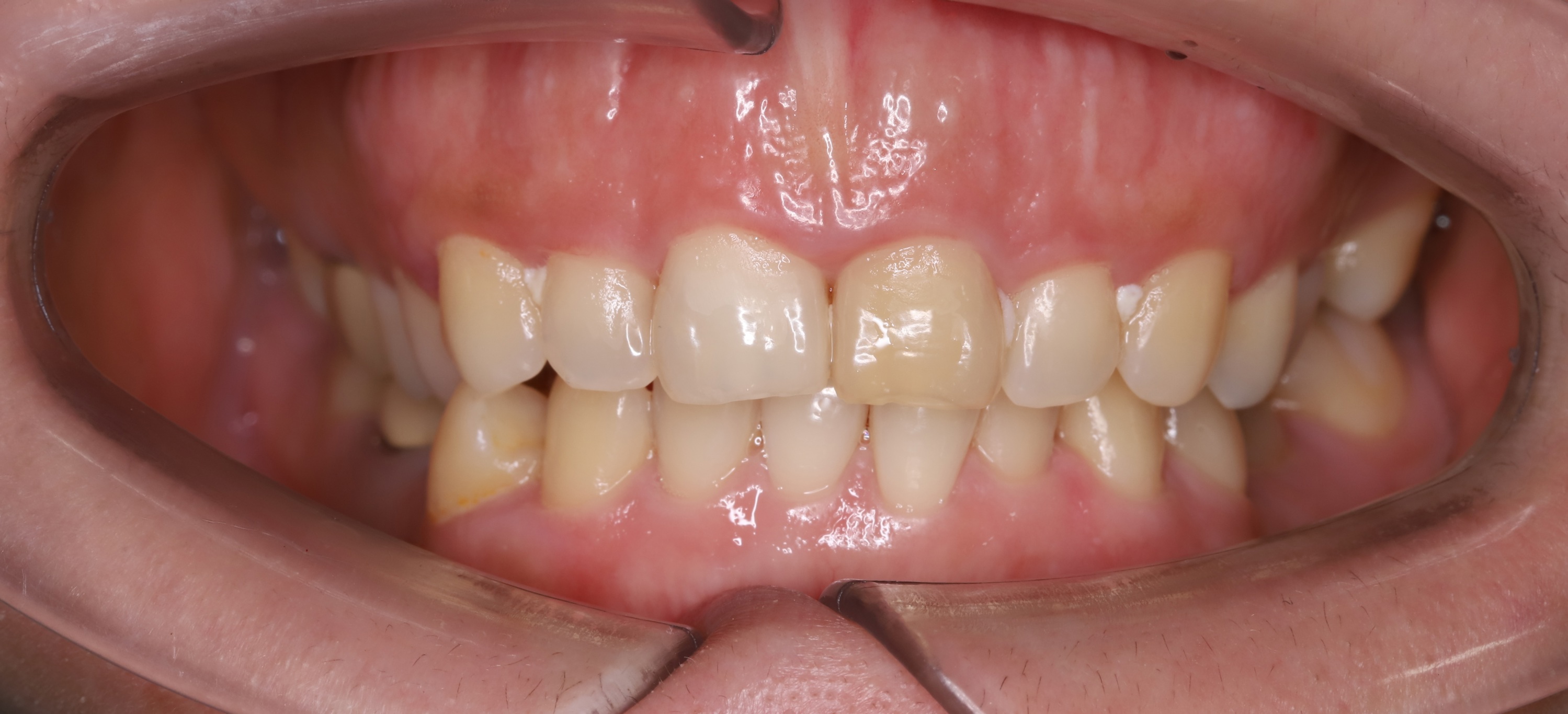 Trước điều trị