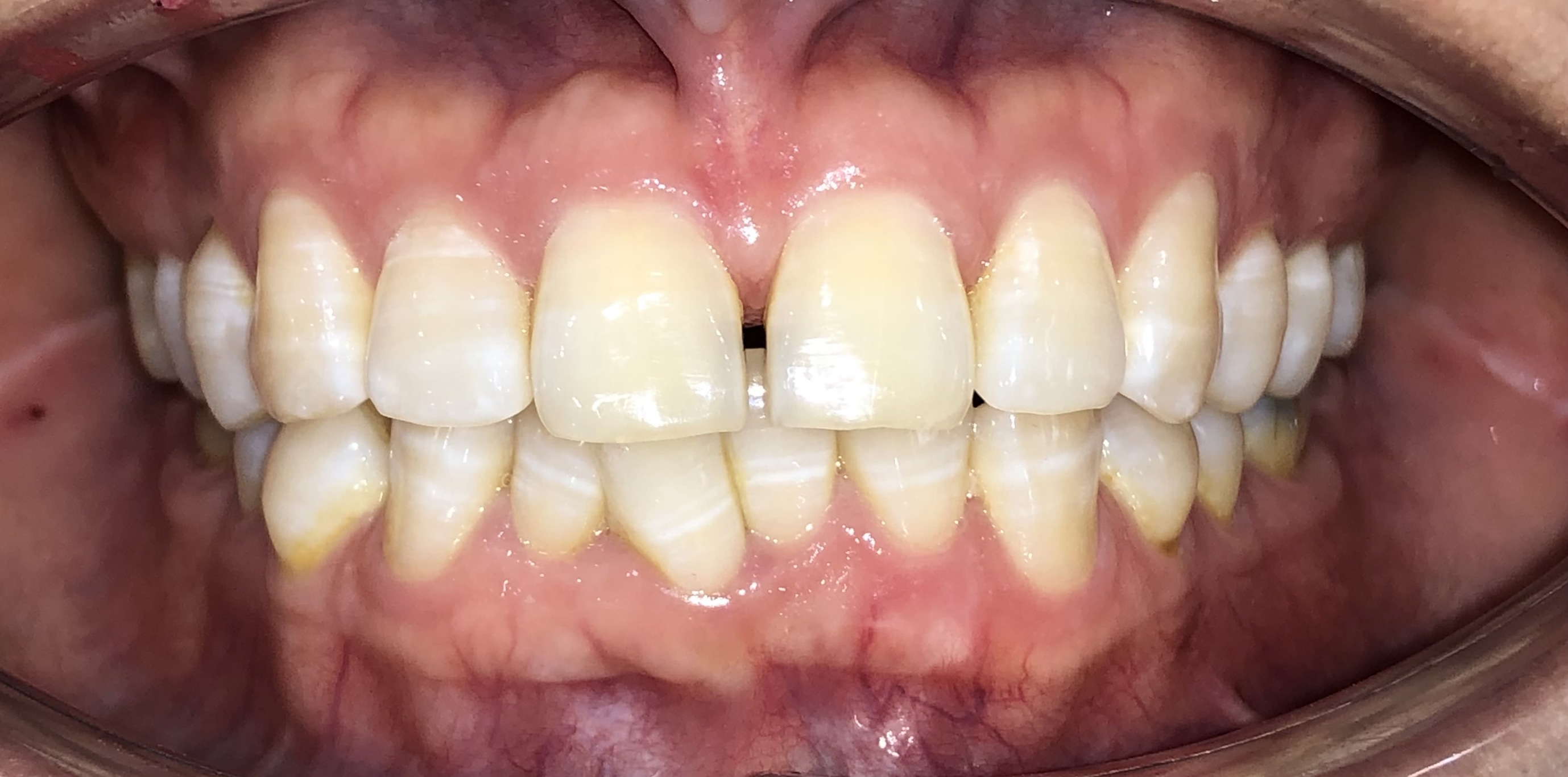 Trước điều trị