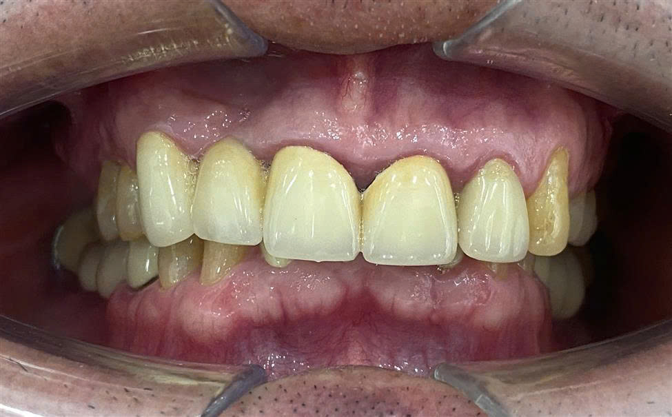 Trước điều trị