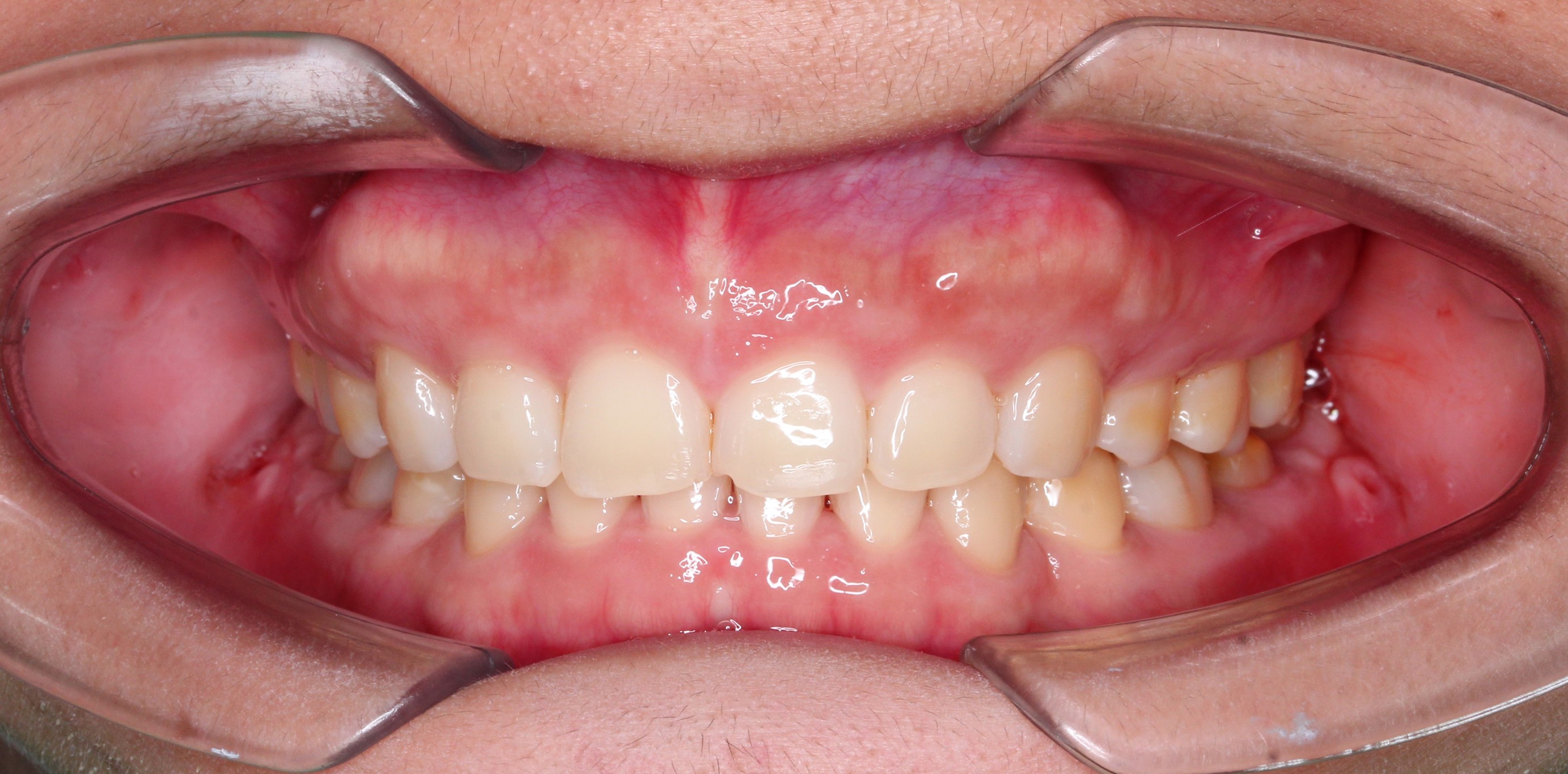 Kết quả điều trị — Completion of ClearCorrect Aligners - Radiant Smile, Timely Tray Removal