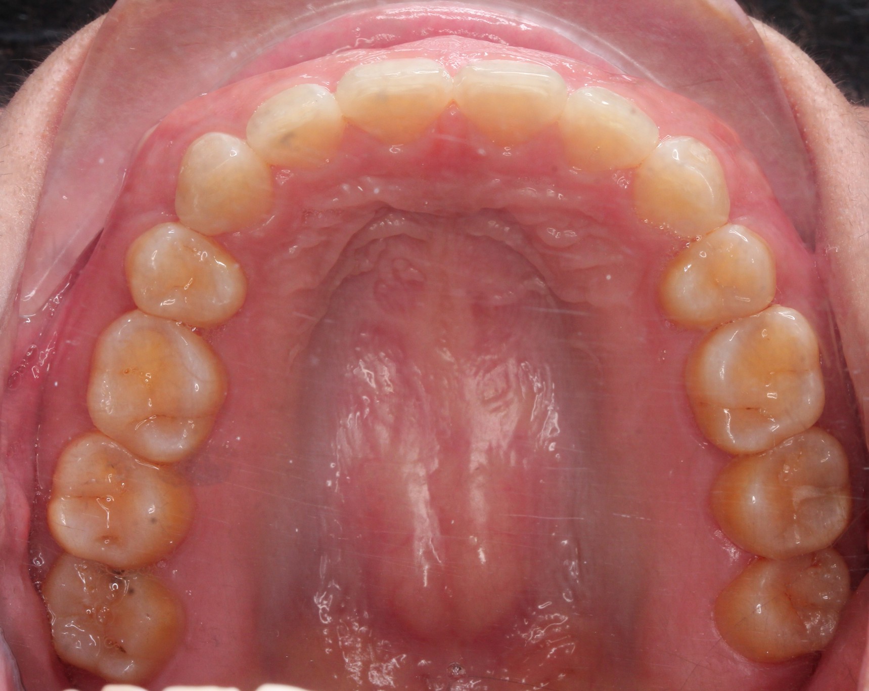 Completion of ClearCorrect Aligners - Radiant Smile, Timely Tray Removal
