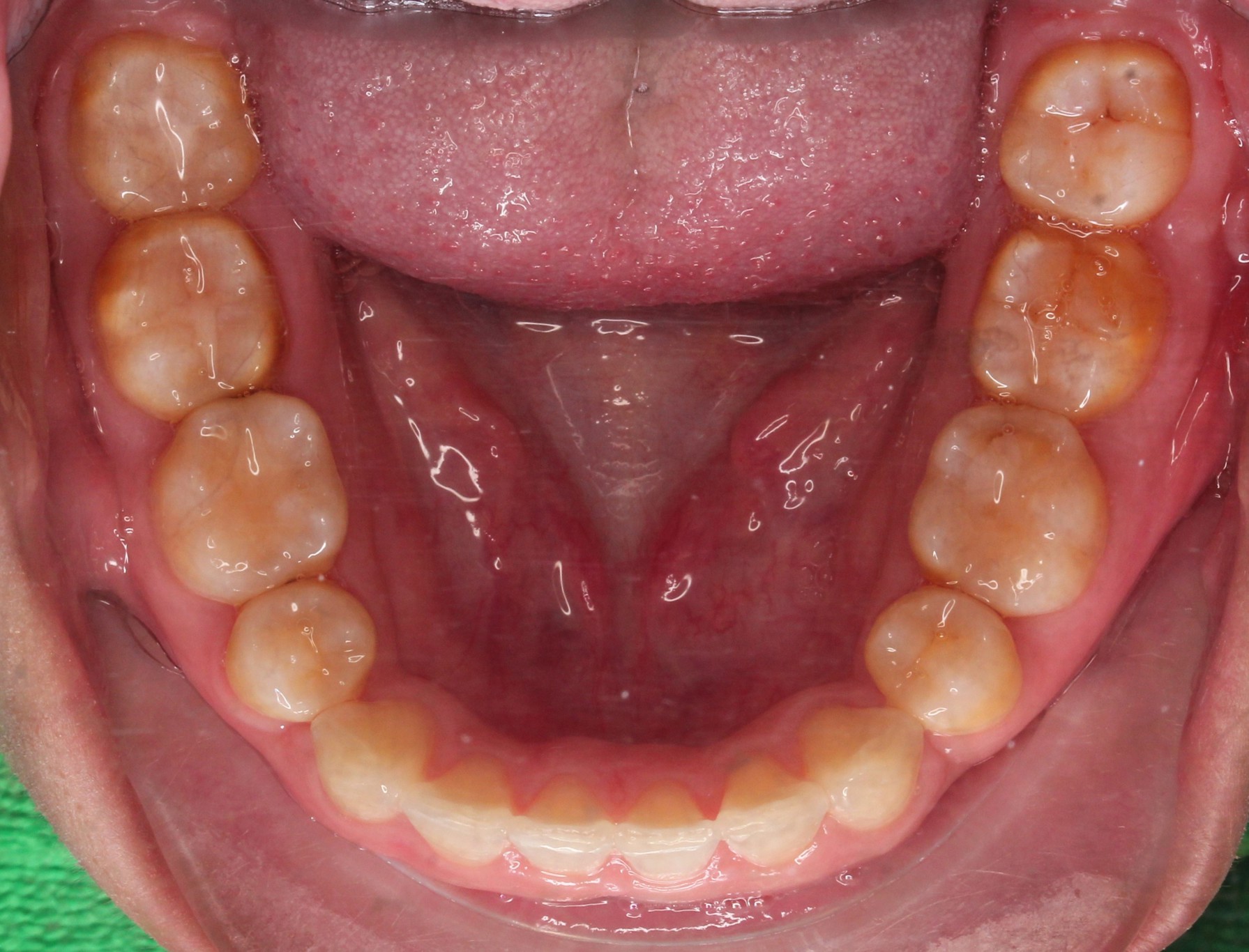 Completion of ClearCorrect Aligners - Radiant Smile, Timely Tray Removal