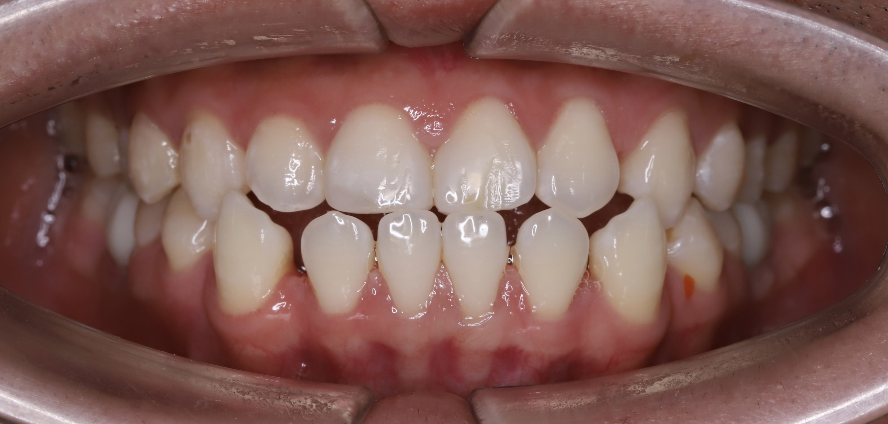 Kết quả điều trị — Cấy ghép Implant BioTem và Phục hình Răng sứ Zirconia – Khôi phục răng hàm