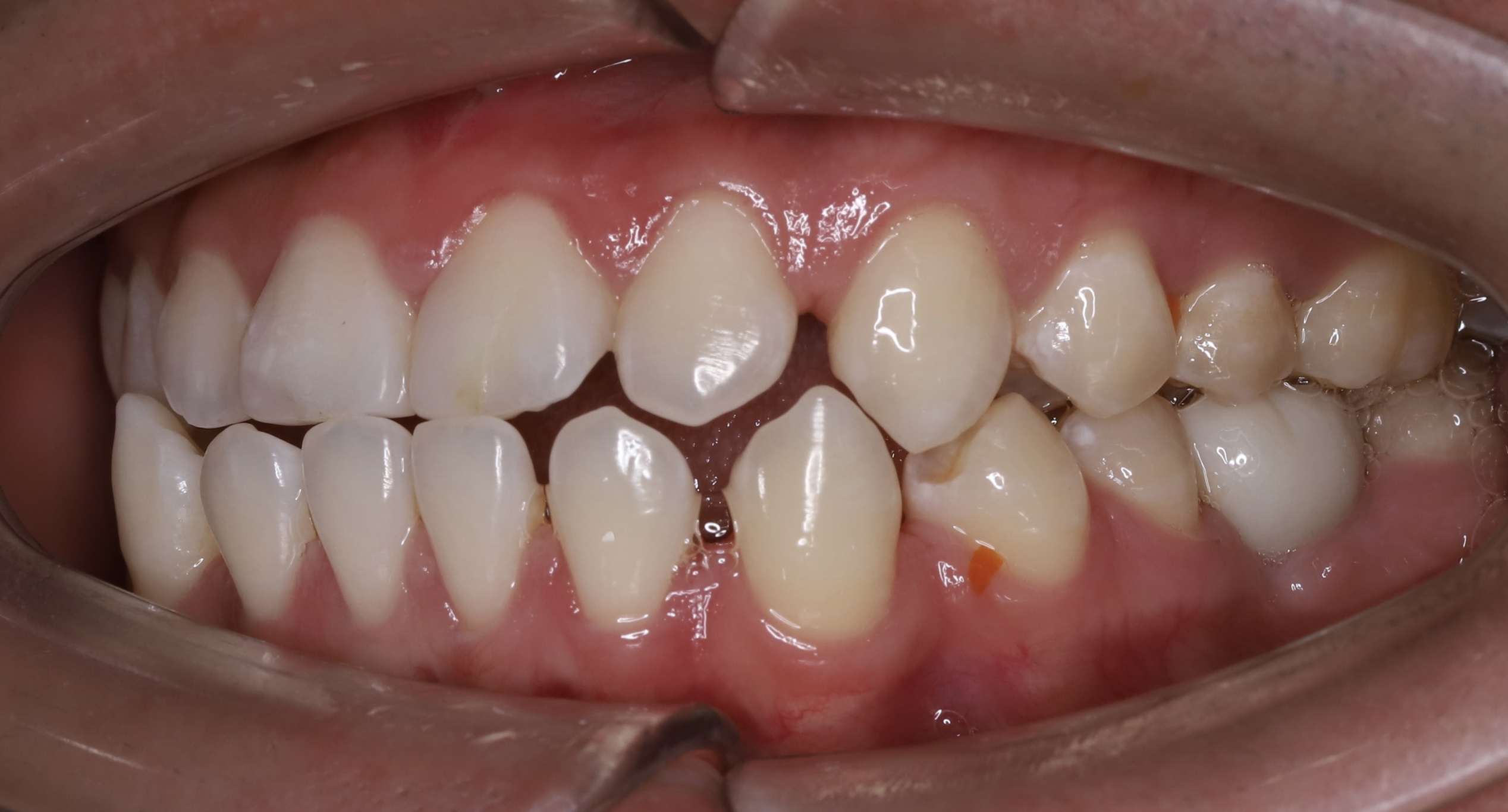 Cấy ghép Implant BioTem và Phục hình Răng sứ Zirconia – Khôi phục răng hàm