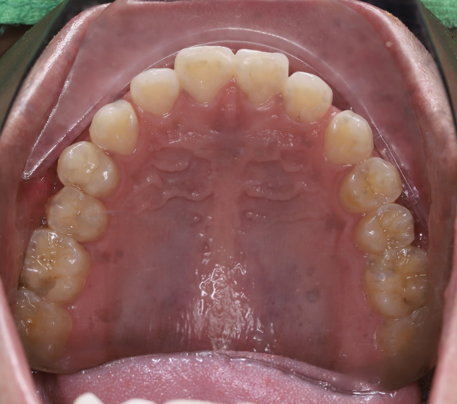 Cấy ghép Implant BioTem và Phục hình Răng sứ Zirconia – Khôi phục răng hàm