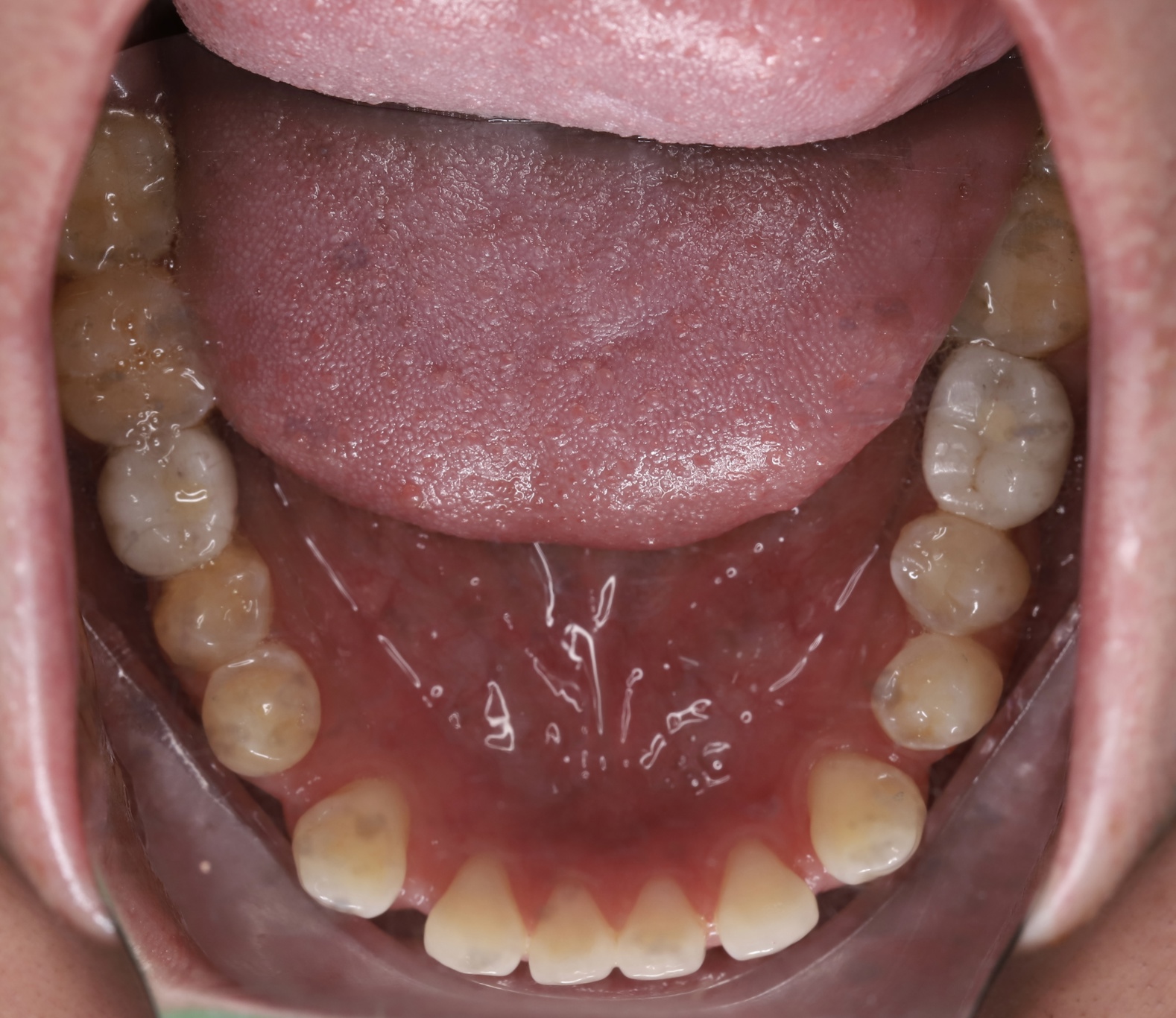 Cấy ghép Implant BioTem và Phục hình Răng sứ Zirconia – Khôi phục răng hàm