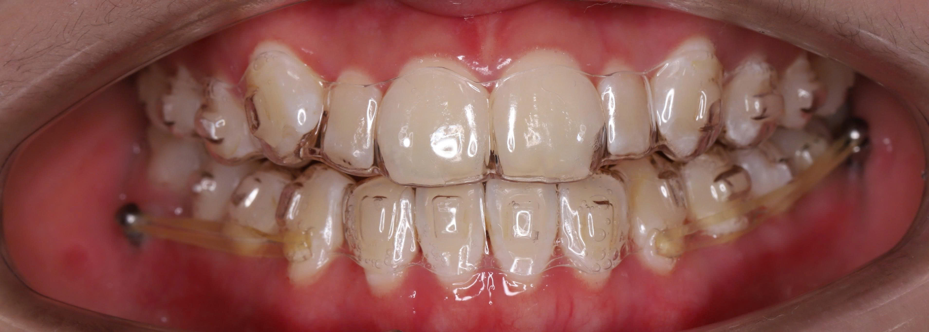 Trước điều trị
