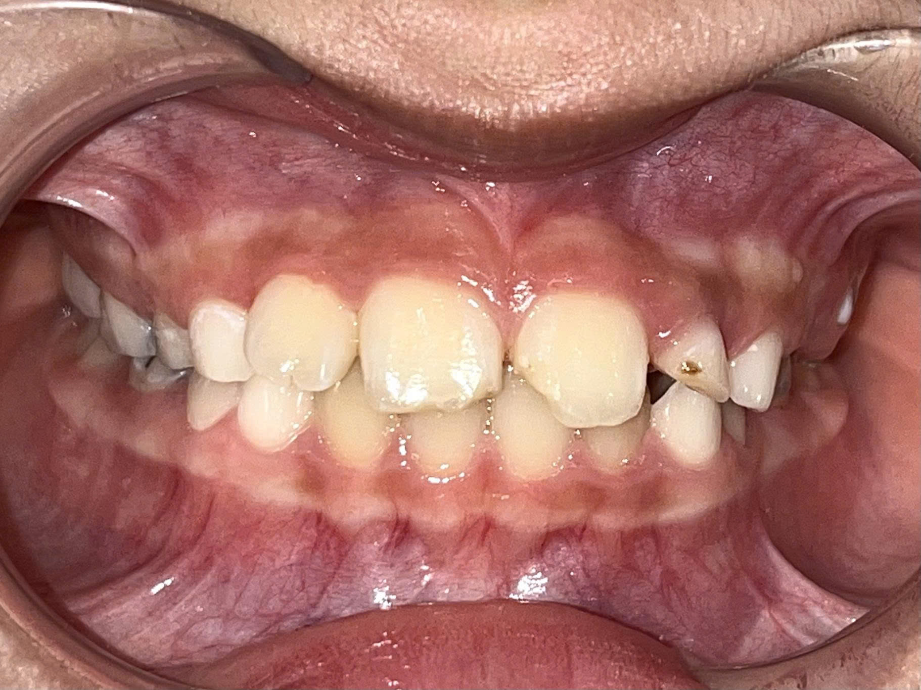Trước điều trị