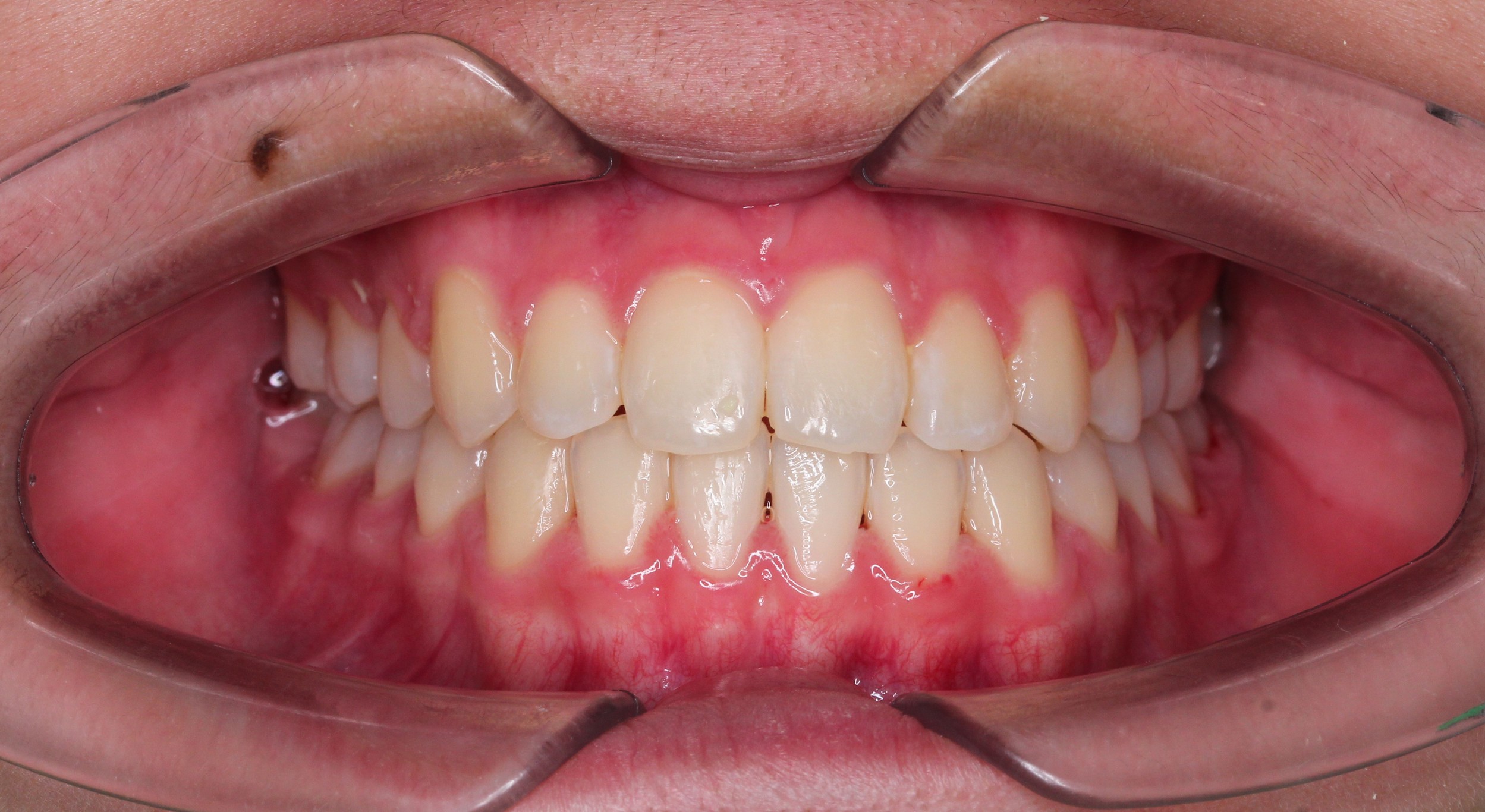 Braces - Correcting Crowded Teeth & Erupting Impacted Teeth