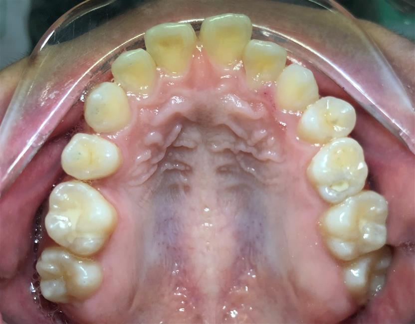 Braces - Correcting Crowded Teeth & Erupting Impacted Teeth