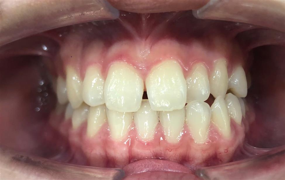 Braces - Correcting Crowded Teeth & Erupting Impacted Teeth