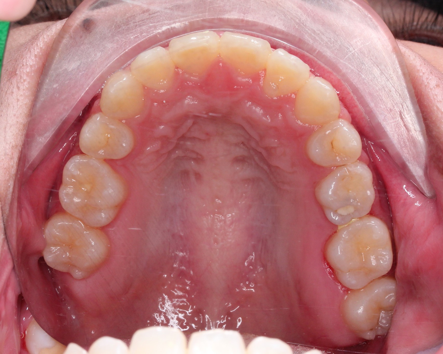 Braces - Correcting Crowded Teeth & Erupting Impacted Teeth