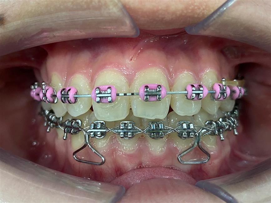 Sau điều trị — Braces - Correcting Crowded Teeth & Erupting Impacted Teeth